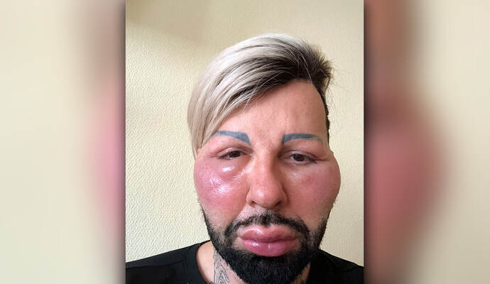Das Gesicht von Harald Glööckler, deutscher Modeschöpfer, ist geschwollen. Der 53-Jährige hat sich wegen einer Allergie im rheinland-pfälzischen Grünstadt in ärztliche Behandlung begeben. Das Gesicht von Harald Glööckler, deutscher Modeschöpfer, ist geschwollen. Der 53-Jährige hat sich wegen einer Allergie im rheinland-pfälzischen Grünstadt in ärztliche Behandlung begeben.