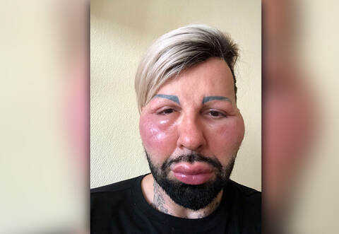 Das Gesicht von Harald Glööckler, deutscher Modeschöpfer, ist geschwollen. Der 53-Jährige hat sich wegen einer Allergie im rheinland-pfälzischen Grünstadt in ärztliche Behandlung begeben.